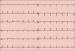 Abb. 1: EKG