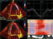 Abb. 9: Speckletracking