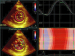 Abb. 10: Speckletracking