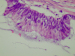 Abb. 2: Appendix - Neoplasma