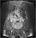 Aktuelles Bild - Abb. 1: VCI - Thrombose
