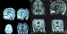 Aktuelles Bild - Abb. 2: Gelastische Epilepsie