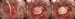 Abb. 3: Hypophysenadenom-Apoplexie