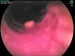 Abb. 2: Tumor - Ösophagus