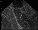 Abb. 4: Gastrinom - Duodenum