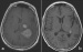 This Image - Fig. 1a-b: Gadolinium Injection