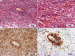Fig. 2a-d: Brain biopsy
