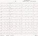 Aktuelles Bild - Abb. 1: STEMI-Hebung