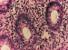 Abb. 3: Lymphozytäre Kolitis
