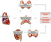 Abb. 1: Aldosteron - Parathormondysregulation