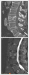 Abb. 7a-b: Sagittaler Spaltbruch