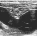 Abb. 2: Aneurysma