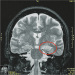 Aktuelles Bild - Abb. 1: Limbische Enzephalitis