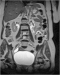 Abb. 1: Arteria-spinalis-anterior-Syndrom