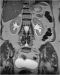 Aktuelles Bild - Abb. 2: Arteria-spinalis-anterior-Syndrom