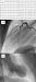 Abb. 1a-c: STEMI