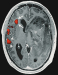 Fig. 3: Brain tumour