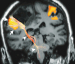 Fig. 4: Brain tumour