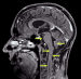 This Image - Fig. 1: Glioblastoma