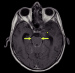 Fig. 2: Glioblastoma