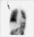 Abb. 1: Lungenperfusionssintigraphie