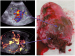 Abb. 2: Placenta praevia percreta