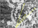 Abb. 2: Endomyokardbiopsie