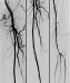 Abb. 3: Ballondilatation