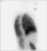 Abb. 2: Lungenperfusionsszintigraphie
