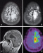 This Image - Fig. 1â-d: Tumour
