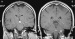Fig. 1a-b: Brain MRI