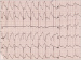 Aktuelles Bild - Abb. 1: Artefakt bei Hyperventilation