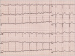Abb. 2: Artefakt bei Hyperventilation