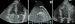 Aktuelles Bild - Abb. 12a-c: Vorhofmyxom - Thrombus