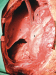 Abb. 3: Thymus - Resektion