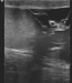 Abb. 2: Spermatozele