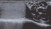 Aktuelles Bild - Abb. 1: Varikozele