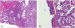 Aktuelles Bild - Abb. 1a-b: Adenocarcinoma