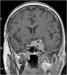 Abb. 1: Sinus-cavernosus-Meningeom