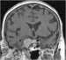 Abb. 4: Sinus-cavernosus-Meningeom