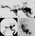 Abb. 2a-d: Karotis-Sinus-cavernosus-Fistel