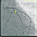 Abb. 1: Initiale Angiographie