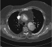 Abb. 2: Aortendissektion