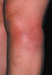 Abb. 1: Erythema nodosum