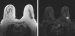 Abb. 2li-re: Mammographie
