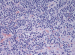 Abb. 3: Lymphom
