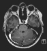 Aktuelles Bild - Abb. 2: Meningeosis carcinomatosa