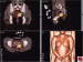 Aktuelles Bild - Abb. 2: DSRCT