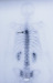 Aktuelles Bild - Abb. 1: Skelettmetastasen