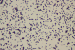 Abb. 6: Skelettmetastasen